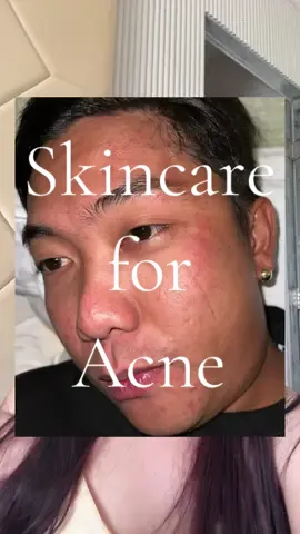 TOP 1 Facial cleanser naman pala kasi #acne #soap #skincare #acnetreatment 