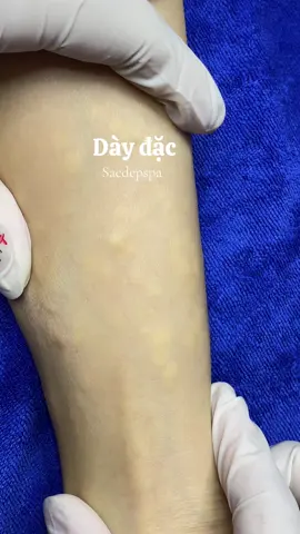 Cượm tay luôn í #truongthuysacdepspa #sacdepspa #trimungovap #spachuyenmun #xh 