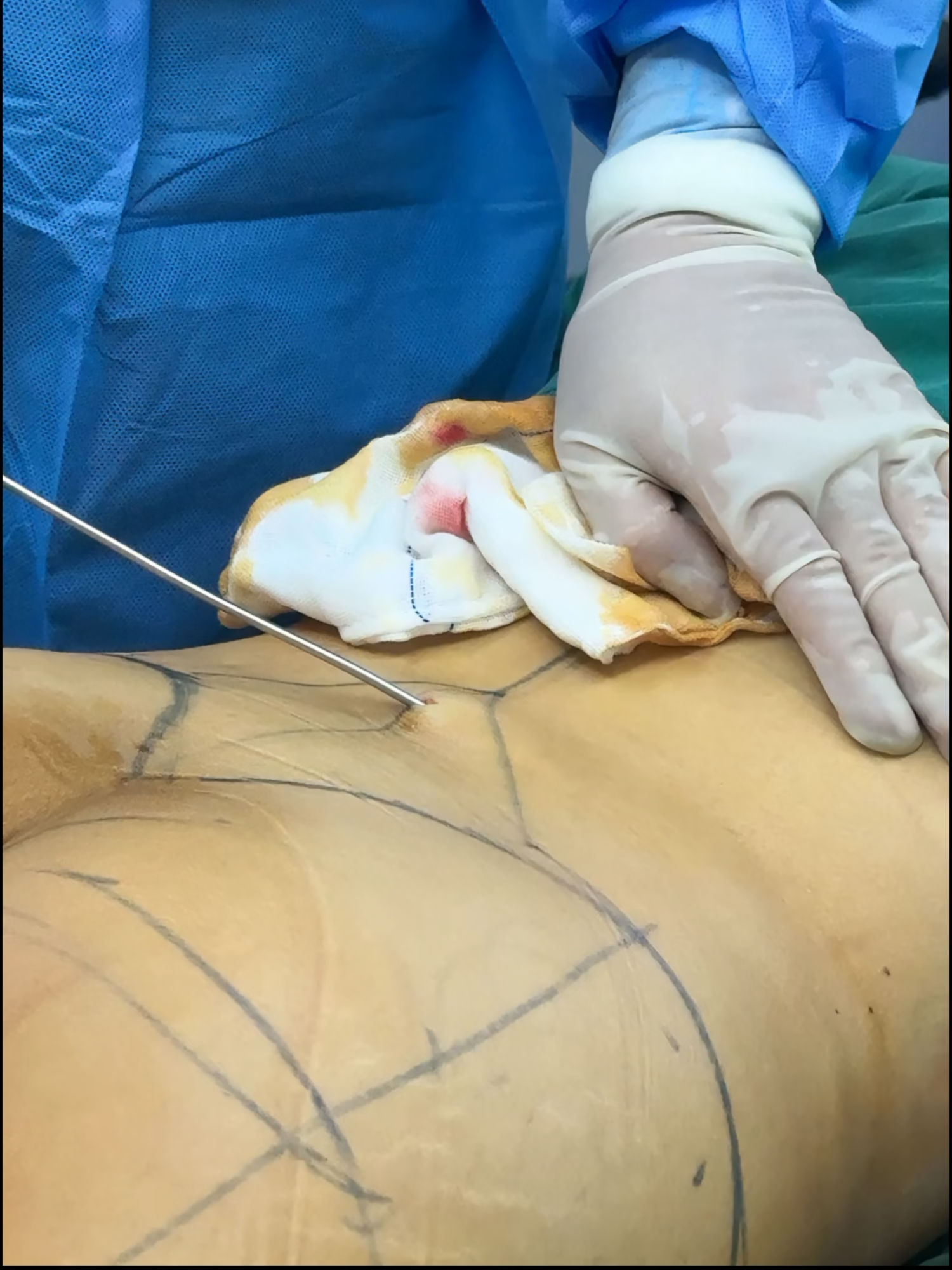 #fy #fyppppppppppppppppppppppp #tiktokindia  The immersive experience of waist and abdominal liposuction can be translated as  “Immersive experience of waist and abdominal liposuction
