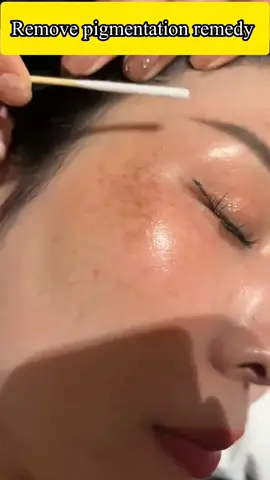 Powerful remedy for pigmentation 