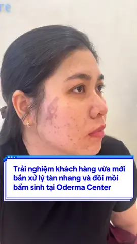 Khách mới bắn xử lý sắc tố tàn nhang và đồi mồi bẩm sinh tại nhà O-Derma Center. Mọi cùng đón chờ kết quả sau 2 tháng nha ❤️ #odermacos #odermacenter #dieutrinam #CaoPhucNguyen #chuyengiaocongnghespa #doimoi 
