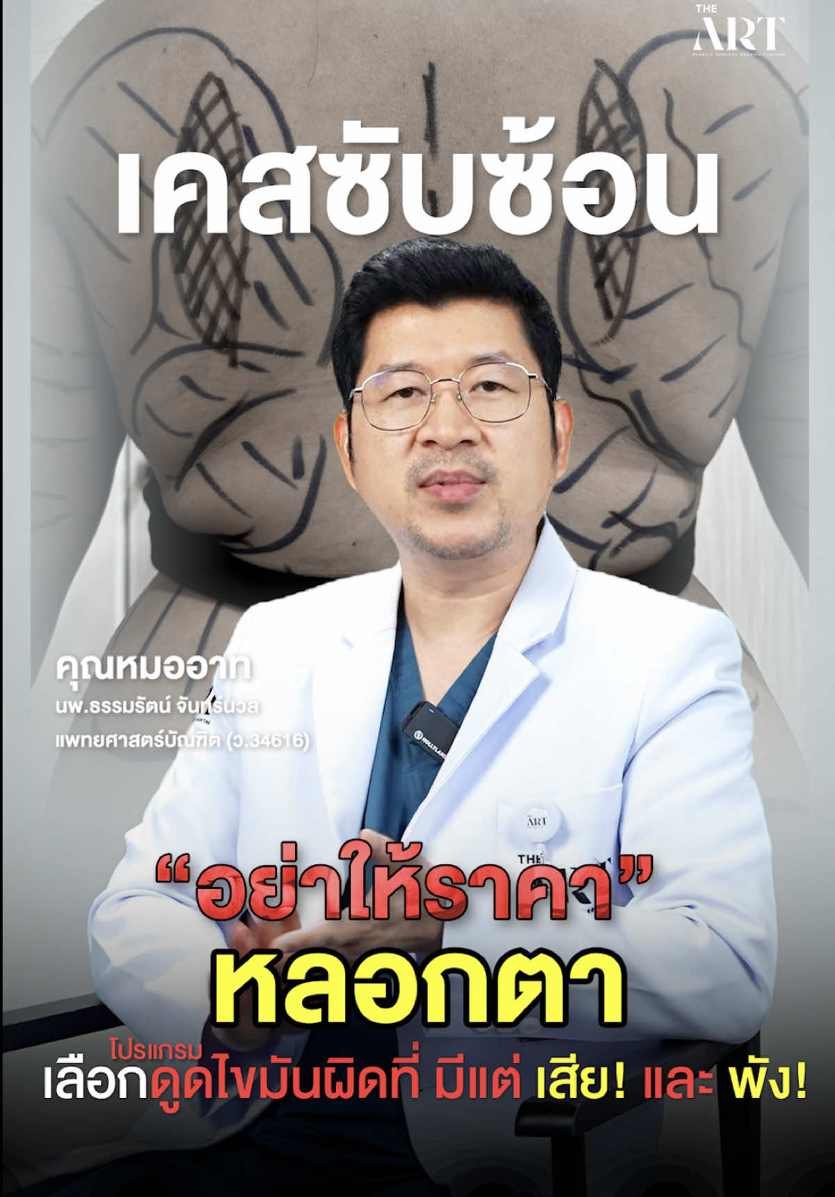 อย่าให้ราคาหลอกตา เพราะดูดผิดที่ มีแต่ เสีย และ พัง! #ศัลยกรรม #หมออาทดิอาท #หมอคิดดิอาท #หมอเบียร์ #ดูดไขมัน #โรงพยาบาลศัลยกรรมดิอาท 