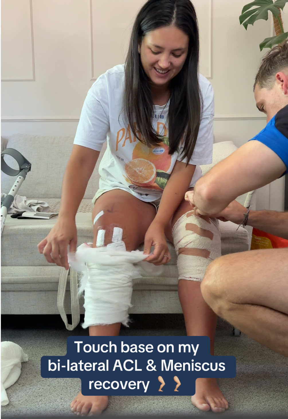 Day 3 feels on recovery - taking my bandages off and putting my stocking and dressings on 🙌🏼 #aclrecovery #aclsurgery #bilateralacltear #bilateralaclsurgery #meniscussurgery #acljourney 