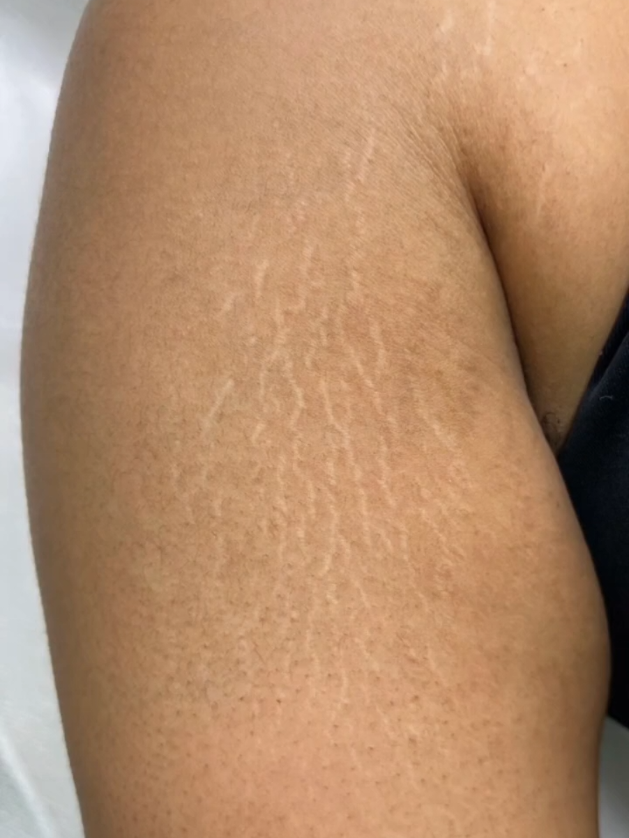 esse creme anti-estrias devolveu a minha autoestima e tirou a minha maior insegurança agora tou viciada tiamo creme rosa💕🔥 #antesedepoisreal #transformacaodapele #estrias  #cremerosa #explorar 