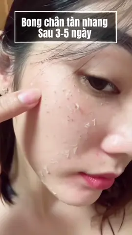 Bong sạch chân tàn nhang sau 3-5 ngày đơn giản tại nhà #khuyle #chamsocda #peel #viral #xuhuong 