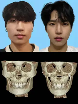 #faceshape #fypmalaysia #medicaltourismchina #vlinesurgery #beforeandafter 