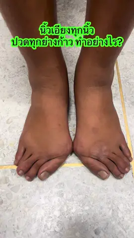 “ทุกก้าวคือความปวด…เพราะนิ้วเท้าเอียงหมดทั้ง 5 นิ้ว! นี่ไม่ใช่แค่ hallux valgus แต่ทุกนิ้วเอียงไปพร้อมกัน การผ่าตัดอาจเป็นทางเลือกให้กลับมาเดินได้โดยไม่มีอาการปวด #halluxvalgus #toe #นิ้วเท้าเอียง #นิ้วหัวแม่เท้าเอียง #polydactyly #osteotomy #minimalinvasivesurgery 