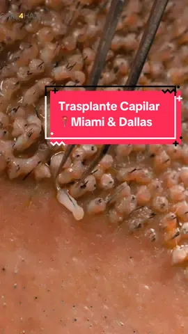💫 El trasplante capilar te devuelve la autoestima y te cambia la vida. De la confianza al estilo — el cambio es real. 📍 Miami y Dallas 📲 Agenda tu evaluación gratuita – 305-262-6070 🌐 care4hairclinic.com #trasplantecapilar #miami #alopecia #care4hair #perdidadecabello #hairtransplant #texas 