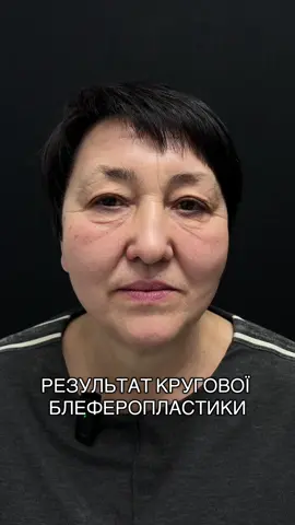 Кругова блефаропластика — це пластична операція, що коригує як верхні, так і нижні повіки одночасно: 	•	прибирає надлишок шкіри та жирові грижі; 	•	зменшує набряклість і «мішки» під очима; 	•	робить погляд більш відкритим та виразним. ⏳ Реабілітація: перші результати видно вже через 2–3 тижні, остаточний ефект — за кілька місяців. 💎 Результат: мінус роки з обличчя, плюс впевненість у собі. Кругова блефаропластика — коли хочеться не змінити себе, а повернути своє свіже, природне «я». #погляд#plasticsurgery#україна #ComproDoPequeno 