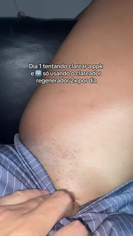 Os humilhados foram exaltados 🥹🤌🏻  #viral #foryou #manchasescuras #foliculite 