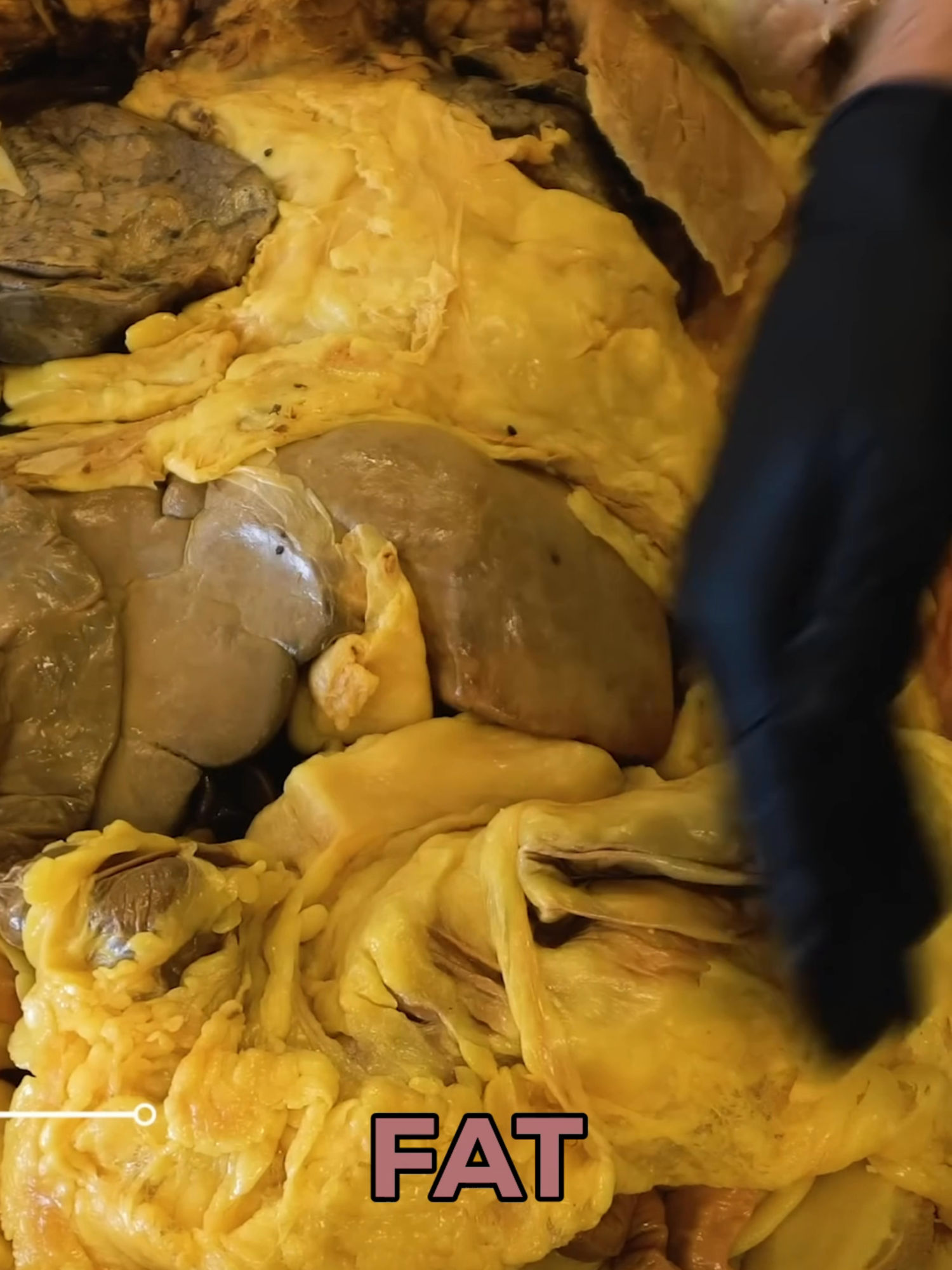 The difference between healthy and unhealthy visceral fat is shocking 😳💔 What you're seeing here isn't just about appearance - it's about your health at the deepest level. Body #1: Excessive visceral fat -Can't even clearly see the heart's pericardial sac -Fat packed around organs and intestines -This level puts serious strain on your body Body #2: Normal visceral fat levels -Clear, distinct pericardial sac around the heart -Much thinner fat layer in abdominal cavity -Organs have room to function properly Why this matters so much: 💔 Increased risk of heart disease 🩸 Higher chance of type 2 diabetes 🦠 Associated with certain cancers 🔥 Releases inflammatory chemicals (cytokines) ⚡ Can cause insulin resistance The scary part: Visceral fat is metabolically ACTIVE. It's not just sitting there - it's actively releasing chemicals that can harm your body from the inside out. Remember: Multiple factors contribute to these conditions, but the strong association with visceral fat makes it a serious health concern we can't ignore. Your organs need space to breathe. This comparison shows exactly why visceral fat is called the 
