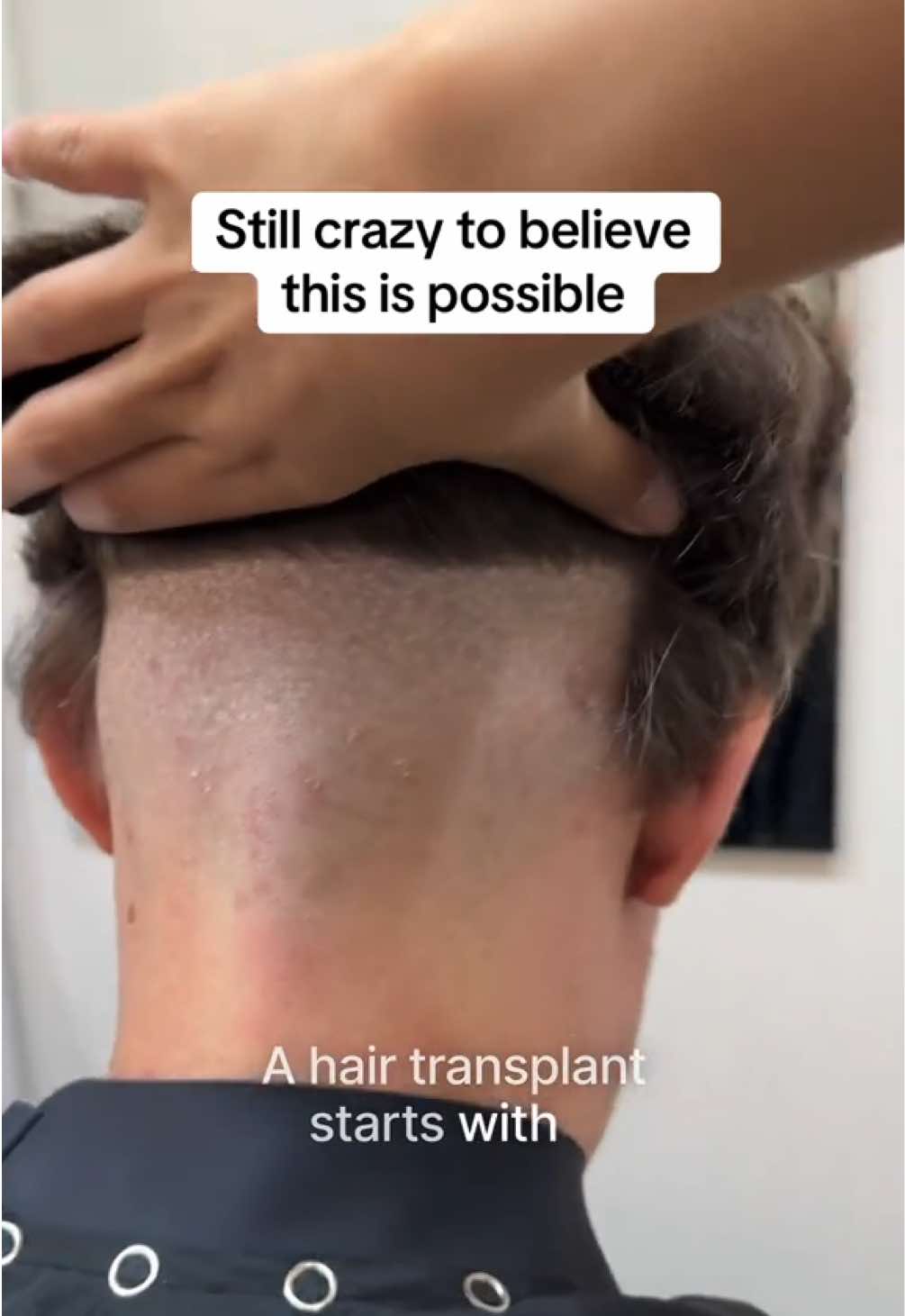 How hair transplants work 💡#hairtransplant #fyp #hairtransformation 