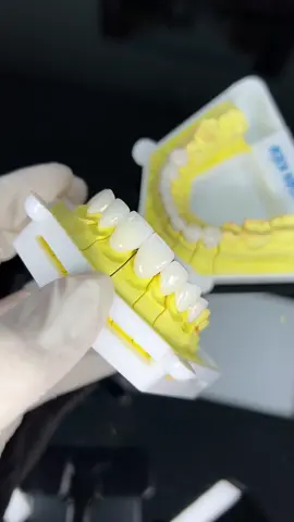 ✨ Hoàn thiện 16 đơn vị sứ cao cấp ✨ Dáng thỏ nhẹ tinh tế, tôn lên từng đường nét gương mặt, tạo nên nụ cười rạng ngời đầy cuốn hút.  #LaboHoankiem #rangsuthammycaocap #rangsuchinhhang #lamrangsu 