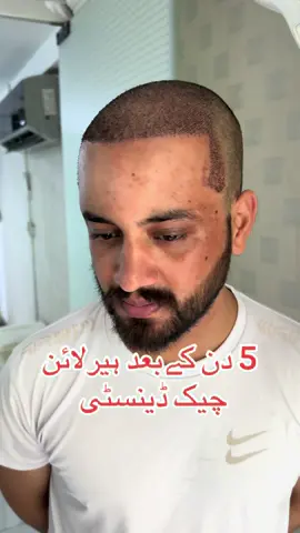 Contact on 03155015084 #hairtransplant #bashirtareen #drbashirtareen 