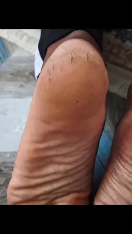 Cara hilangkan tumit merekah, Kaki licin dan bersih.  #tumitpecah  #kakilicin  #footgrinder  #beforeafter  #TiktokMadeMeBuyIt 