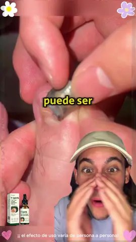 ¿Uñas amarillas, gruesas y agrietadas? Probar #unex #toebbl #toenailreconstruction #nailfungus #nailfungustreatment  