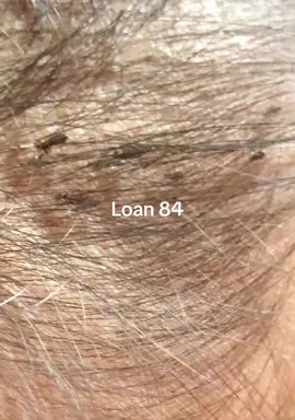clean lice #lice #😱😱😱 #omg😱😱 #trending 