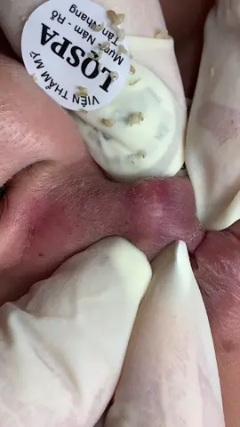 Ngứa chịu không nổi phải lấy giúp khách- [ ] #chamsocdaseo#chamsocda#chamsocdamun#chamsocdanam#tanbinh        