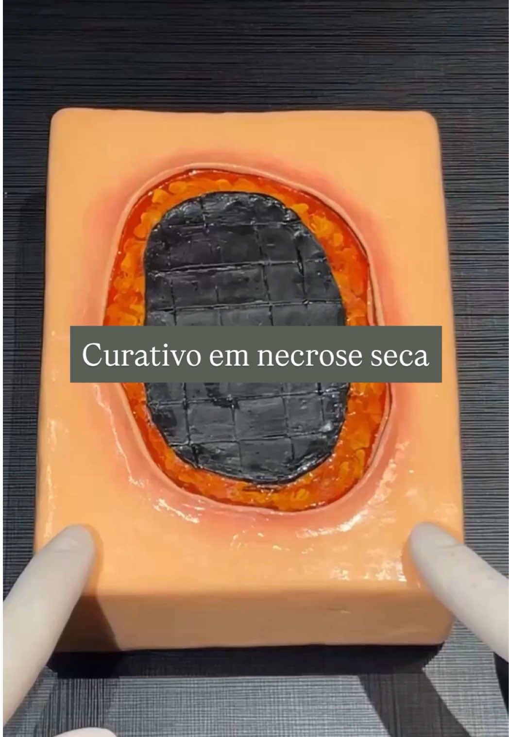 carlacavazana Curativo em Ferida com Necrose: Passo a Passo! Depois da limpeza, faça a escarotomia com a lâmina de bisturi, aplique a cobertura de escolha, use o spray barreira para proteção e finalize com a cobertura secundária. Esse vídeo foi útil para você? Então já me segue por aqui!