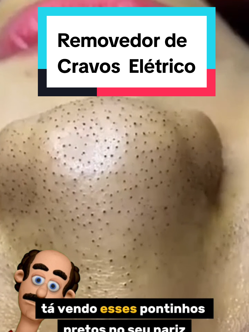 Sabe aqueles cravos e acnes na sua pele? Não precisa pagar caro em limpeza de pele. Confira esse limpador removedor de cravos elétrico e resolva seu problema, amorzinho.  #cravos #removedordecravos #limpezadepele #pele #pelesaudavel 