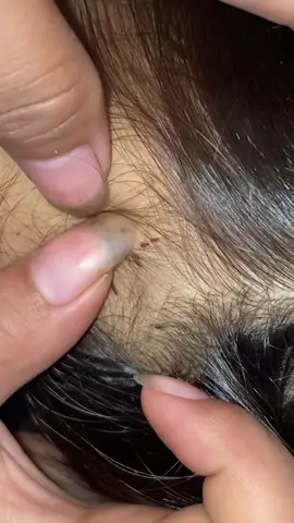 😱😱😱😱😱#omg #lice #liceremoval 