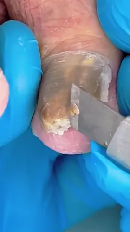 #pedicure #footcare #nailscare #nails#pedicuretools #podologia #relax #feetcare #toenail #toenailremoval #nailfungus #fyp#ingrowntoenail#decompression#foryou