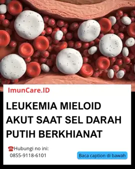 Leukemia Mieloid Akut (AML) adalah kanker darah agresif yang menyerang sel mieloid di sumsum tulang. 📌 