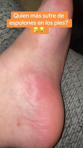 Que dolor 😫 #espolon #pies #parati 