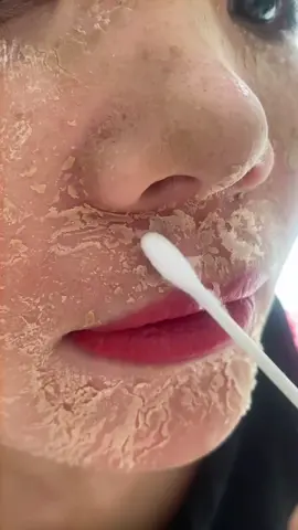 Da bong sau 3 ngày #video #xuhuongtiktok #videotiktok #peelda #lamdep #tàn_nhang #spa 