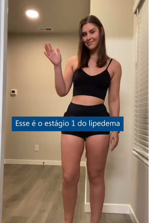 Visivelmente magra, mas com Lipedema: o que o corpo mostra vai além da balança. ⚠️ Esse é o estágio 1 do Lipedema, uma condição crônica que afeta a forma como a gordura é distribuída no corpo, e que muitas vezes passa despercebida ou é confundida com outros problemas. Sintomas comuns incluem: ✔️ Pernas retas e sem definição; ✔️ Pele com textura irregular e aspecto de “casca de laranja”; ✔️ Formação frequente de hematomas; ✔️ Acúmulo de gordura ao redor dos joelhos; ✔️ Acúmulo de gordura nos braços e/ou ao redor das articulações; ✔️ Tronco pequeno e sem alterações. Mesmo em mulheres magras, o Lipedema pode estar presente, causando desconforto físico e impactando a autoestima. O diagnóstico precoce é essencial para evitar a progressão da doença e indicar o tratamento adequado. 👉 Se você se identificou com algum desses sinais, toque no link da bio e agende sua consulta. Vamos investigar com seriedade e cuidar da sua saúde e bem-estar. #lipedema #tratamentolipedema #cirurgiaplastica #lipedemaconcept #lipedemabrasil #drfelipebrito #fbclinique 