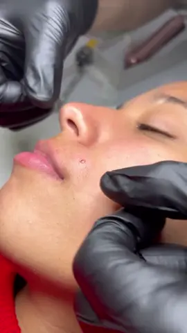 #pimple #fly #satisfatório #fyp #viral 