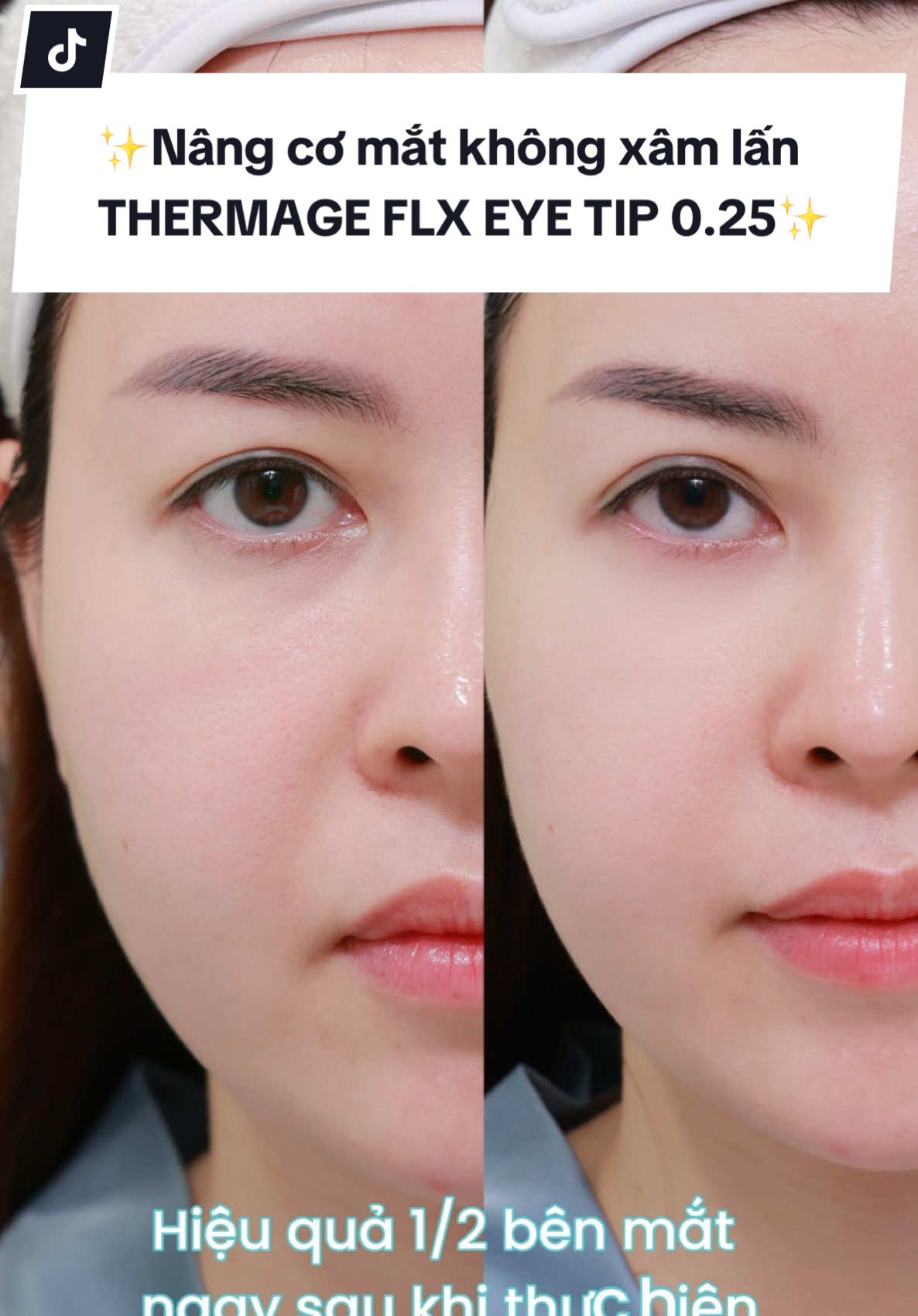 Mắt của CEO @Tâm and Blossom trước và sau khi thực hiện trẻ hoá bằng công nghệ Thermage FLX Eye Tip 0.25 ✨ #blossom #blossomclinic #thermage #blossomaestheticclinic #tamandblossom 