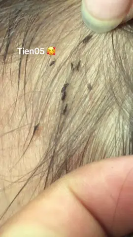 Remove lice #olebrandselect #lice 😘😘😘😘#omggggg ❤️❤️❤️❤️