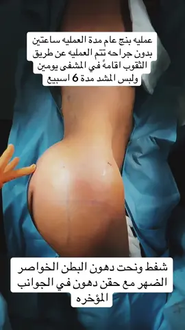 نحت البطن وحقن الدهون#نحت #اسطنبول #هولندا#فلسطين #فرنسا🇨🇵_بلجيكا🇧🇪_المانيا🇩🇪_اسبانيا🇪🇸 