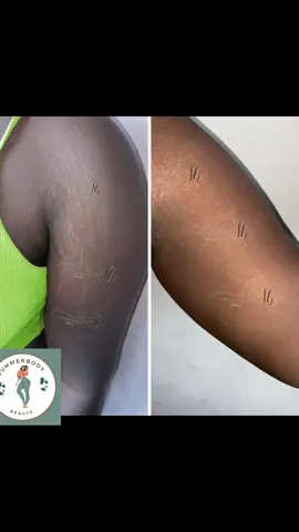 Waoooh !!, incroyable à voir, un beau résultat de vergetures  Vergeture dakar  vergeture senegal  vergeture c quoi  produit efficace pour vergeture  anti vergeture  vergeture traitement  vergeture blanche  bio vergeture  astuce vergeture  anti vergeture efficace traitement vergeture rapidement vergetures  trend vergetures  photo anti vergeture vergeture traitement crème vergeture Rew Dindi rew Stretch marks #vergetures #stretchmarks #rew #vergeturetraitement  #vergetureseffacees  #savonvergeturepeeling #traitementvergeture 