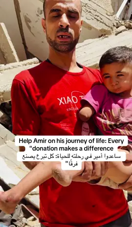 Amir from Gaza, living in a tent, dreaming of prosthetic limbs. Every donation is a new hope. Campaign link in the Bio. #DonateNow #HelpAmir