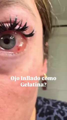 ⚠️ Tu ojo se ve así, como ‘inflado’? Esto se llama quemosis y ocurre cuando la conjuntiva (la capa transparente que cubre el ojo) se llena de líquido. Las causas más comunes son: 👁️ Alergias 👁️ Infecciones como conjuntivitis 👁️ Irritación por lentes de contacto Soy la Dra. Diana Parra, oftalmóloga. Sígueme para más consejos y prevención visual @oftalmologa  #OjoRojo #Quemosis #Conjuntivitis #Alergias #LentesDeContacto        