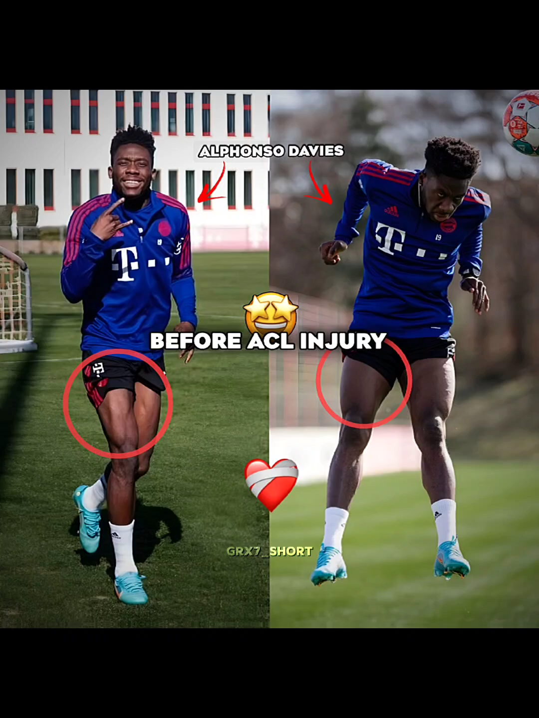 Alphonso Davies Leg Change After ACL Injury  #football #footballtiktok#Soccer #fyp #fypシ゚viral #fypシ #foryou #foryoupage #viral #viralvideo #viraltiktok #trending #alphonsodavies