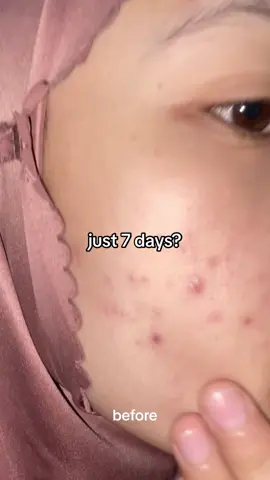 best banget serumnya🥹❤️ #seoul1988 #ksecret #skincarekorea #7days #serumkorea #rekomendasiserum #riviewserum #acneserum #poreserum #retinal #racunskincare #skincareampuh #pejuangacne 