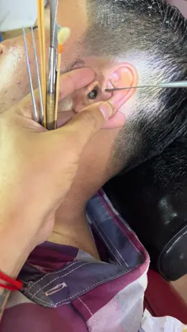 #earwaxremoval #removal #cleaning #asmr #United States
