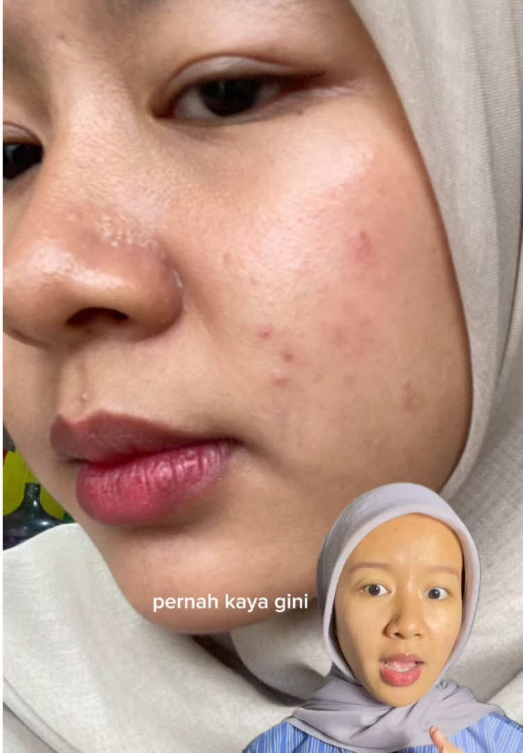 drama bekas jerawat dan darkspot emang gak pernah ada abisnya deh dari dulu☹️ #skincare #skintips #elsheskin  #DailyRoutine 