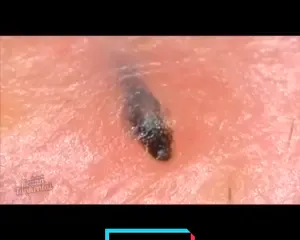 Remoção de pelo encravado #satisfyingvideo #videosatisfatorio #foryou #foryoupage❤️❤️ #cravos 