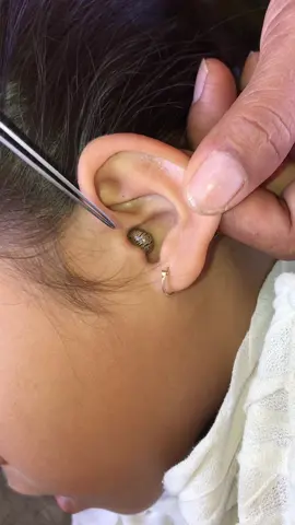 #😱 #ticks #ticksremoval #foryou #fyp 