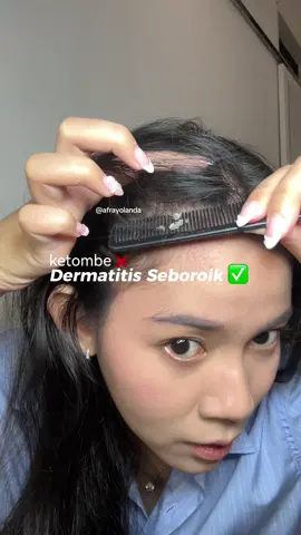 poin plusnya gabikin rambut cepet lepek & rambut kering #eksim #dermatitisseboroik  #KERAMASTANPADRAMA #Biotalk @Biotalk.id 