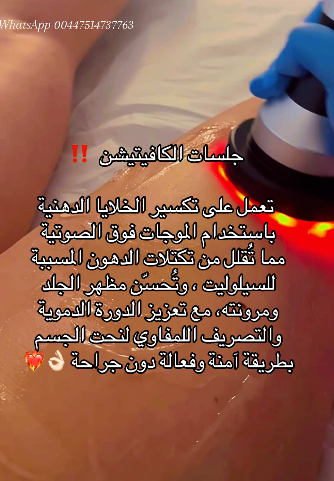 الكافيتيشن 💯 #عيادة_تجميل_لندن #بريطانيا_لندنlondon🇬🇧🇬🇧 #viral  #خسارة_دهون #السيلوليت 