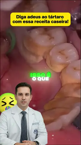 Receita caseira para resolver problema dental!#dentesbrancos #podre #bafo #tartaro 
