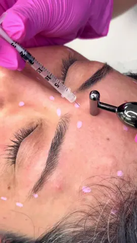 Let’s get some B o t o x ✨💖 . . . #cosmeticclinictj #aestheticmedicine #botox #dysport #wrinkletreatment 