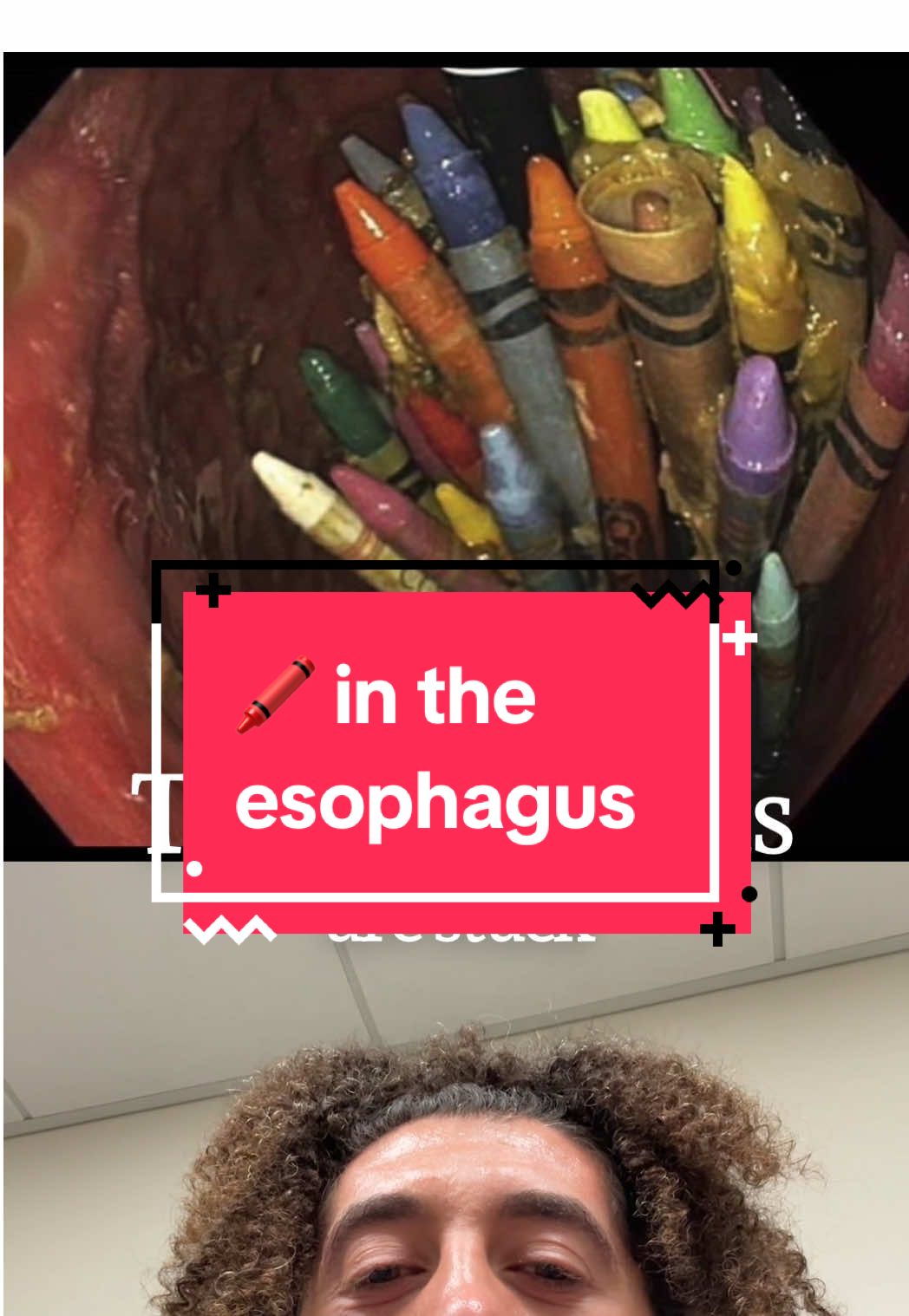 Case study time 📚🖍️ A woman swallowed multiple crayons that got stuck in her esophagus. CT scan ➡️ endoscopy ➡️ crayons removed. One of the more unusual cases you’ll see in medicine. #CaseStudy #MedicalCase #Endoscopy #Radiology #DoctorLife