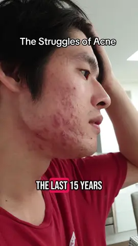 #acne #insecurities #model #skincare #therealmattchong 