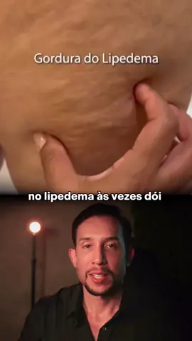 Dor para caminhar.   😔 Vergonha de usar saia.   🥺 Críticas por não emagrecer. Esse é o dia a dia de muitas mulheres com lipedema — doença crônica que afeta até 11% das mulheres. ❌ Não é preguiça   ❌ Não é falta de dieta   ❌ Não é “relaxar” ✅ É acúmulo desigual de gordura, inflamação e dor.   ✅ É físico e emocional.   ✅ É invisível para quem julga. Não tem cura.   Mas tem melhora:   • Dieta low carb anti-inflamatória   • Exercício de baixo impacto   • Mounjaro   • Drenagem linfática   • Meias de compressão   • Antioxidantes naturais 💬 Você já tinha ouvido falar disso?   🔁 Compartilha. Pode mudar a vida de alguém que sofre em silêncio.